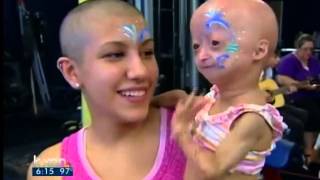 Adalia Rose holds fundraiser for Progeria [upl. by Arais]