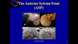 Brain Talk Craniometric points of the skull [upl. by Eleon]