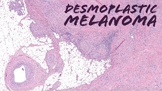 Desmoplastic Melanoma with Immunohistochemistry UNC Case 1 dermpath dermatology pathology [upl. by Douty]