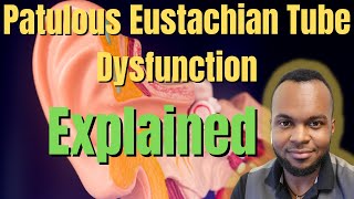 Patulous Eustachian Tube Explained 3 Things To Be Aware Of [upl. by Losiram]