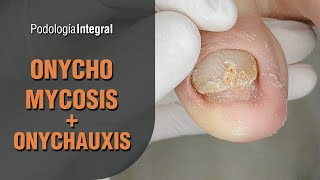 Onychomycosis  Onychauxis podology asmr [upl. by Donahoe]