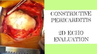 Constrictive pericarditis  2D ECHO evaluation [upl. by Acina]