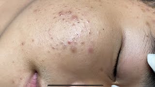 ACNE TREATMENT VU QUYNH MI  Perennial Blackheads On Boy Face 2024FULL [upl. by Yetac]