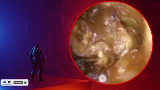 The Truth About earwax Will Shock You How to remove earwax from ear earwax extractions [upl. by Sandi]