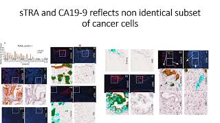 sTRA amp CA199 glycans express nonidentical subset of pancreatic cancer cell populations Code 695 [upl. by Deevan593]