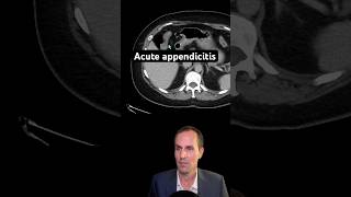 Abdominal CT Tutorials  Acute appendicitis [upl. by Ainevuol]