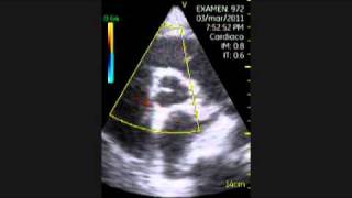 VSCAN Cardiomyopathy of Hypothyroidism Pocket ultrasound Cardiopatía en hipotiroidismo [upl. by Gerardo]