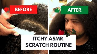 ASMR Scalp Flake Removal Routine Session for Soothing Relief [upl. by Ahsinyar203]