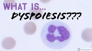 What is Dyspoiesis on peripheral blood smear A short explanation Hemepath amp Hematology [upl. by Leelahk338]