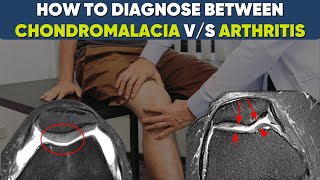 Chondromalacia vs Osteoarthritis of kneewhat’s the difference drpankajwalecha [upl. by Enicnarf]