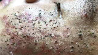 Blackhead Removal With Sac Dep Spa 100074091 [upl. by Infield269]