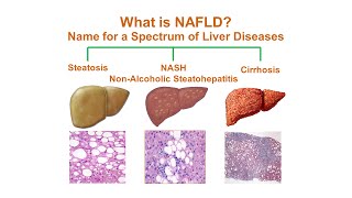 What is NonAlcoholic Fatty Liver Disease NAFLD [upl. by Torp]