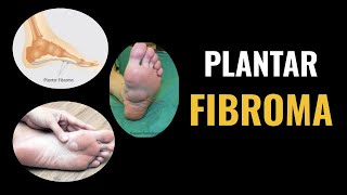 Plantar Fibroma [upl. by Ahsoek207]