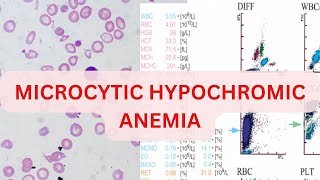 MICROCYTIC HYPOCHROMIC ANEAMIA  CASE BASED DISCUSSION  IDA  THALESSEMIA  AOCD SIDERBLASTIC [upl. by Starobin]