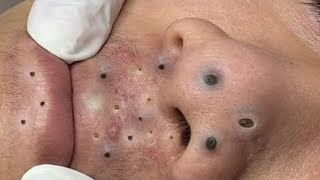 Acne treatment Blackhead remove with Spa Loan [upl. by Aneehc139]