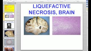 Medical School Pathology 2012 Session 003 Cell Adaptation Injury Death Lecture and Labmp4 [upl. by Tayler]