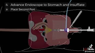 LaparoscopicAssisted Percutaneous Endoscopic Gastrostomy PEG Tube Placement Steps [upl. by Courtnay]