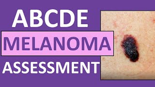 ABCDE Melanoma Skin Cancer Assessment Nursing with Pictures [upl. by Burch]