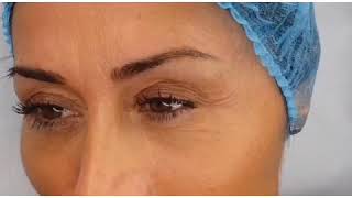 Infoltimento sopracciglia con Microblading peli effetto realistico [upl. by Htebirol]