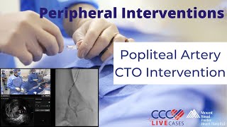 Watch Live Popliteal Artery CTO Intervention [upl. by Nwahsd]