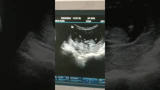 30f pelvic pain mild blooding 12weeks pregnancy [upl. by Nevins]