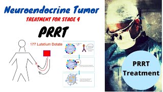 PRRT Treatment Neuroendocrine Tumors [upl. by Mala]