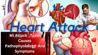 Heart Attack ll Myocardial Infraction ll BSc Nursing [upl. by Aiciruam]