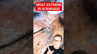 Shocking BLACKHEAD REMOVAL  Extreme Blackhead Extraction shorts [upl. by Nert]