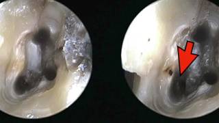 Maxillary Sinusitis of Endodontic Origin A Call to Action Part 2 of 2 [upl. by Erland]