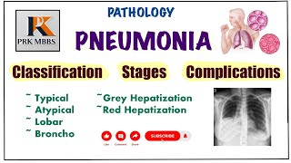 Pneumonia Pathology  Stages Of Pneumonia  Complications amp Lung Abscess pathology robbins [upl. by Orms]