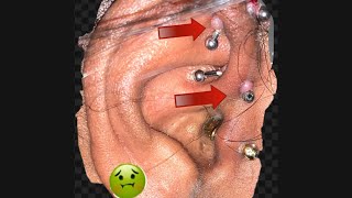 Fast and easy way to get rid of piercing bumps Photos included 🤢🤮🤮🤢 [upl. by Ewen669]