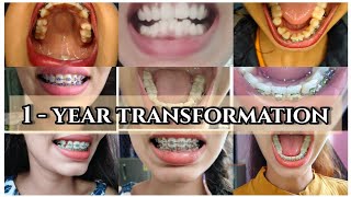 Before and after braces time lapse 1 year braces transformationbraces bracesupdatebracessmile [upl. by Kizzie]