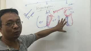 Cardiomyopathytypes and pathophysiology [upl. by Atiuqat]