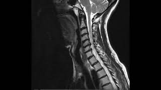 Anatomía RM Cervical [upl. by Aja]