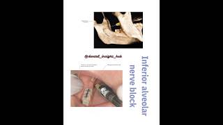 Inferior alveolar nerve block oralsurgerydentistrydentalinsighthubtoothextraction [upl. by Marci639]