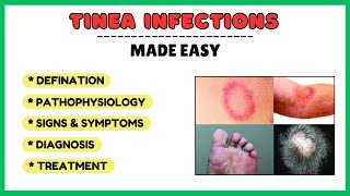 Tinea infection fungal skin infection types of tinea pathophysiology diagnosis treatment [upl. by Palocz]