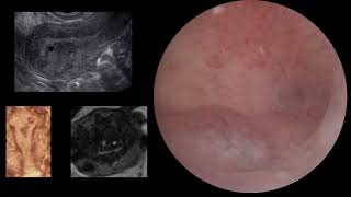 Stepwise approach of hysteroscopic cytoreductive surgery foradenomyosis in patients with recurren [upl. by Jareb232]