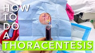 How to Do A Thoracentesis [upl. by Strander]