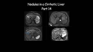 Nodules in a Cirrhotic Liver  Part 14 radiology radiologist cirrhosis liverdisease liverhealth [upl. by Elkin]