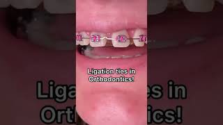 Types of ligation with Braces  Tooth Time Family Dentistry New Braunfels Texas [upl. by Barolet]