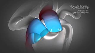 Shoulder Arthroscopy  Rotator Cuff Repair [upl. by Alyat]