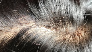 Remove Thousands Of Nits Remove Lice Getting Lice All From Long Hair [upl. by Ardle]