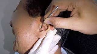 Removing Huge Hard Earwax From Elderly Mans Ear [upl. by Rolyat]