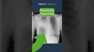 Understanding Lobar Pneumonia 🫁 MedicalEducation usmle [upl. by Xila]