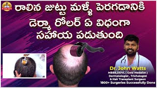 Derma Roller For Hair Growth  డెర్మా రోలర్ ఉపయోగించే విధానం  DrJohn Watts  Trichos [upl. by Nylrehs905]