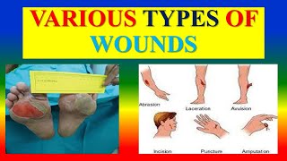 VARIOUS TYPES OF WOUNDS [upl. by Anuala]