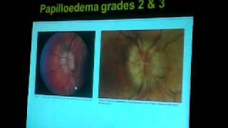 Fundus Exam Papilledema Papillitis [upl. by Anu]