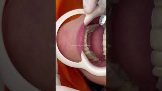 Profilaxia dentária com uso de fio dental com cabo e pasta profilática profissional periodontia [upl. by Aiker386]