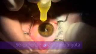 Técnica Crosslinking Corneal para pacientes con Queratocono realizada en Clínica Coro [upl. by Epp754]