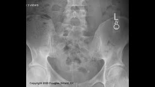 Posterior Sacral Anatomy  Two Malformations of the Lumbosacral Joint Sacralization  Lumbarization [upl. by Heinrike]